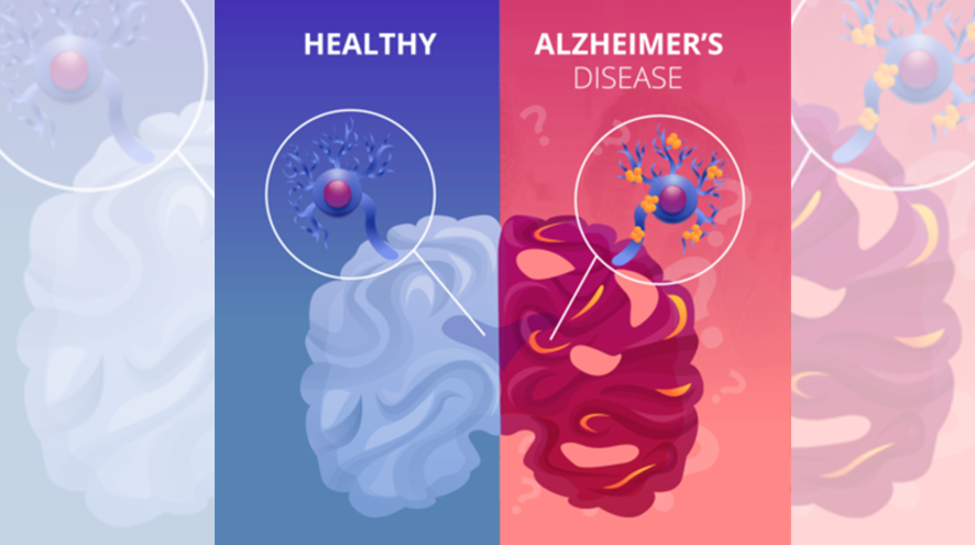 Healthy Blue Brain vs. Alzheimer Disease Red Brain