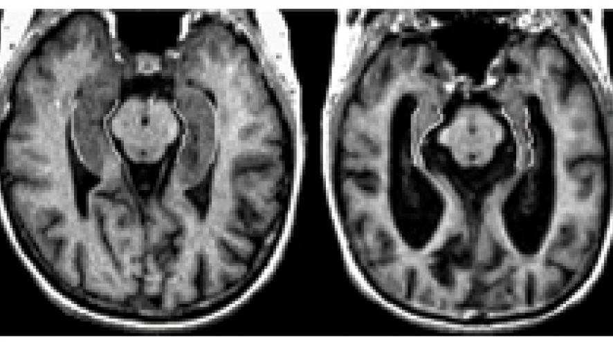 MRI scan of the brain
