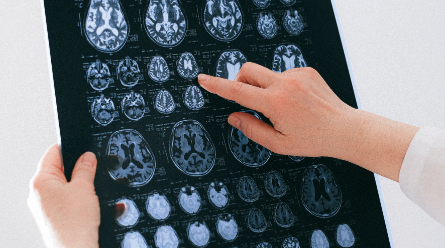Pexel.com image of a person's hands pointing at brains on a scan
